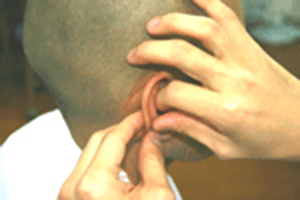 耳鍼療法